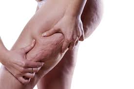 Cellulite