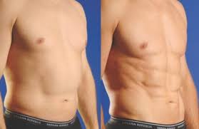 Body Contouring Procedures for Men