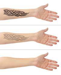 Laser Tattoo Removal
