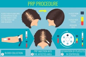 hair transplant