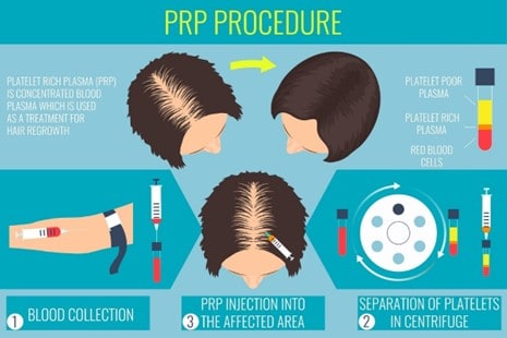 hair transplant